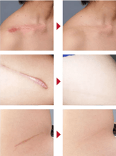 Load image into Gallery viewer, Gel Scar Therapy Patch